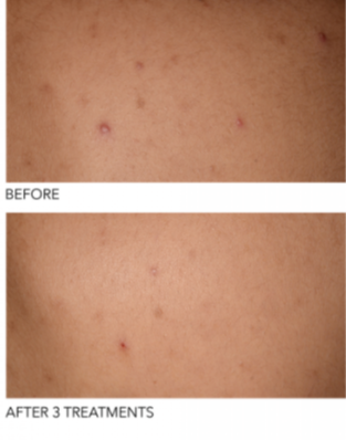 Alpha Beta® Exfoliating Body Treatment Peel 8 Pk - Millo Jewelry