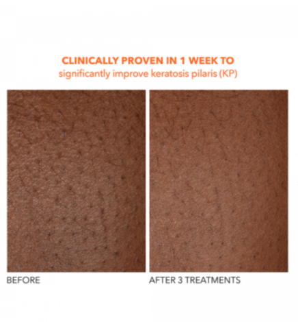 Alpha Beta® Exfoliating Body Treatment Peel 8 Pk - Millo Jewelry