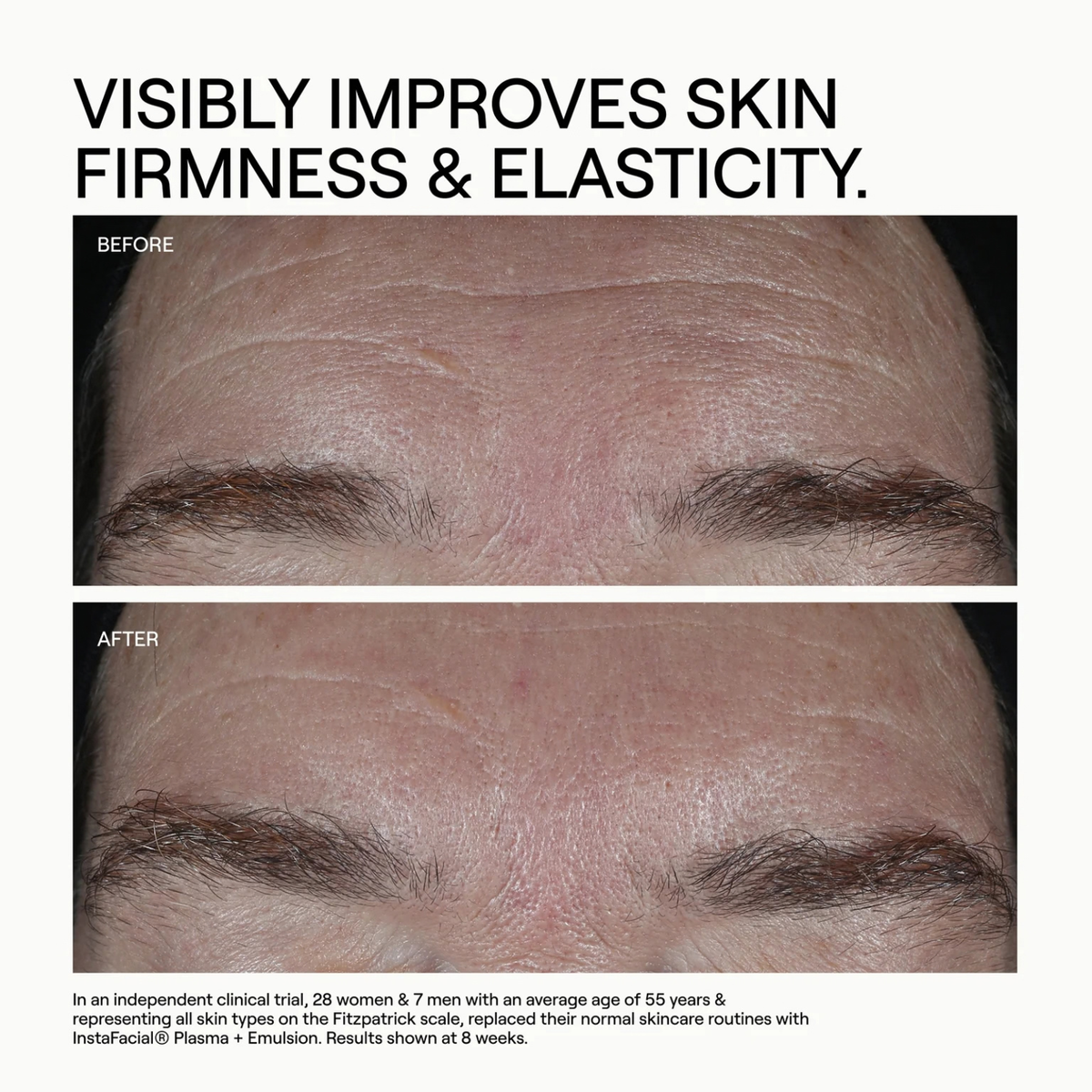 INSTAFACIAL® PLASMA